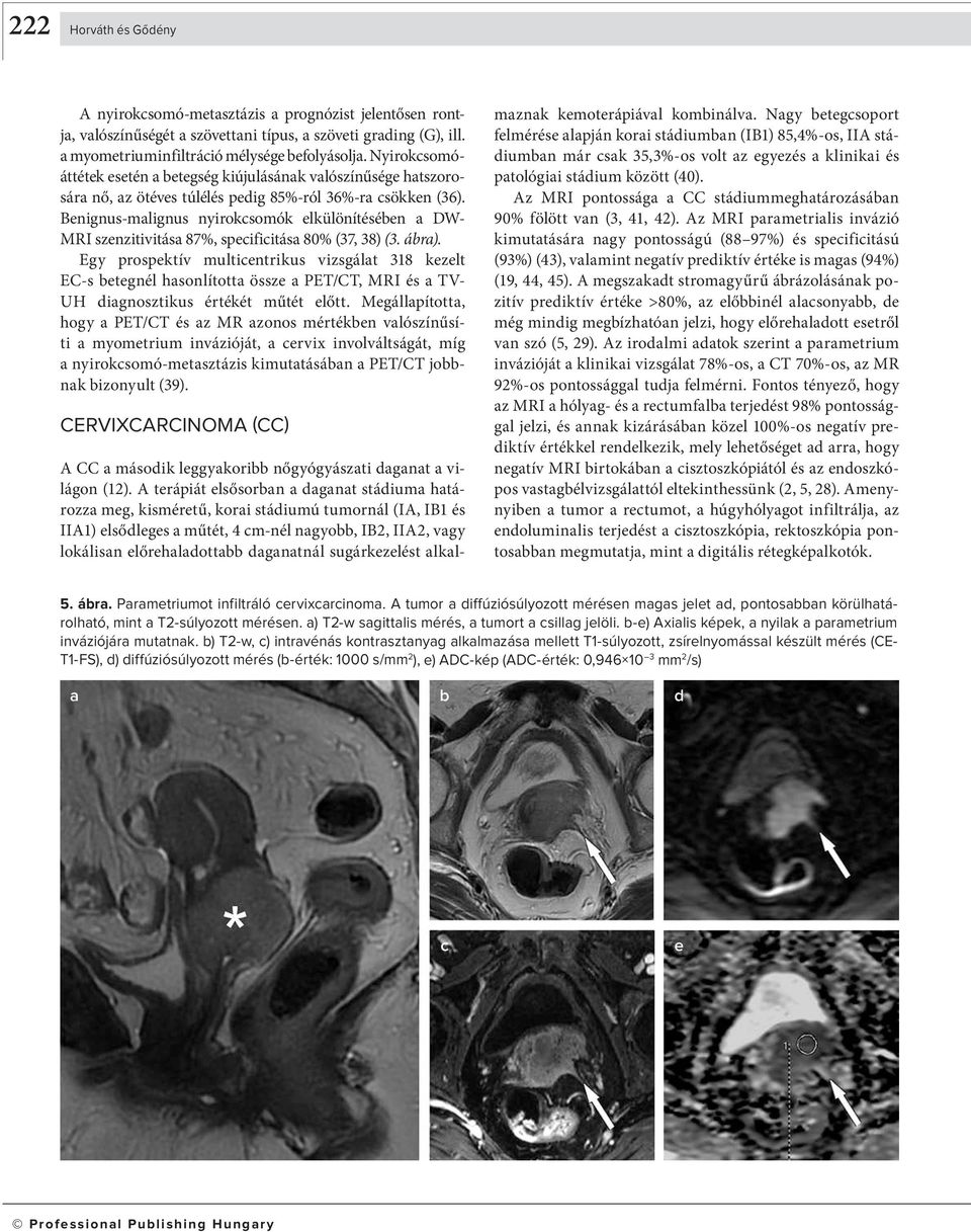 Benignus-malignus nyirokcsomók elkülönítéséen a DW- MRI szenzitivitása 87%, specificitása 80% (37, 38) (3. ára).