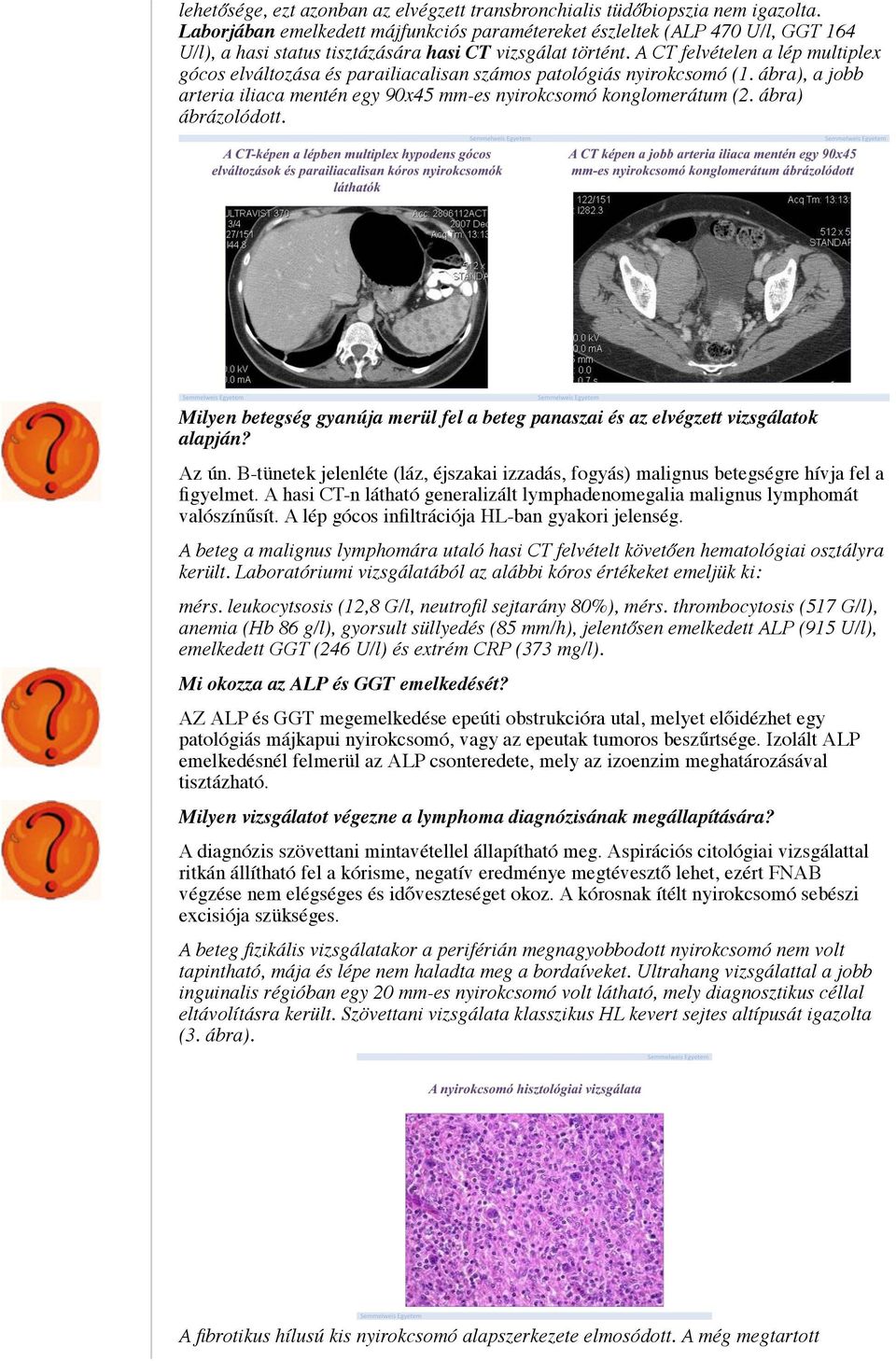 A CT felvételen a lép multiplex gócos elváltozása és parailiacalisan számos patológiás nyirokcsomó (1. ábra), a jobb arteria iliaca mentén egy 90x45 mm-es nyirokcsomó konglomerátum (2.