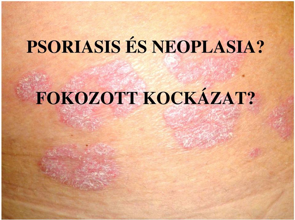 NEOPLASIA?