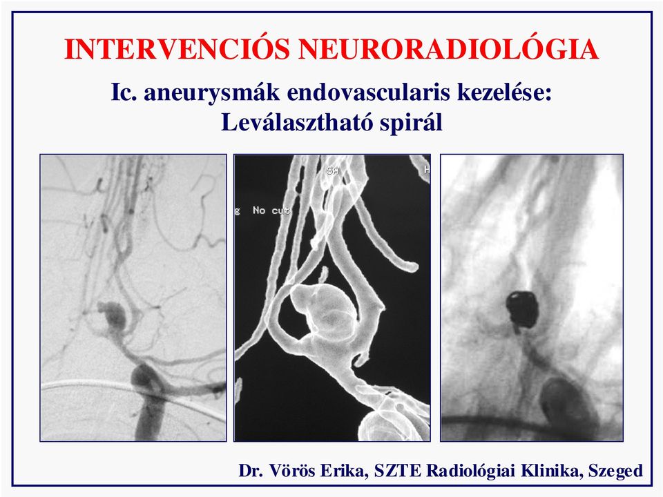 kezelése: Leválasztható spirál Dr.