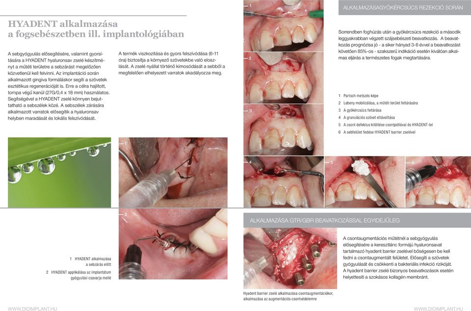 Az implantáció során alkalmazott gingiva formáláskor segíti a szövetek esztétikus regenerációját is. Erre a célra hajlított, tompa végű kanül (27G/0,4 x 18 mm) használatos.