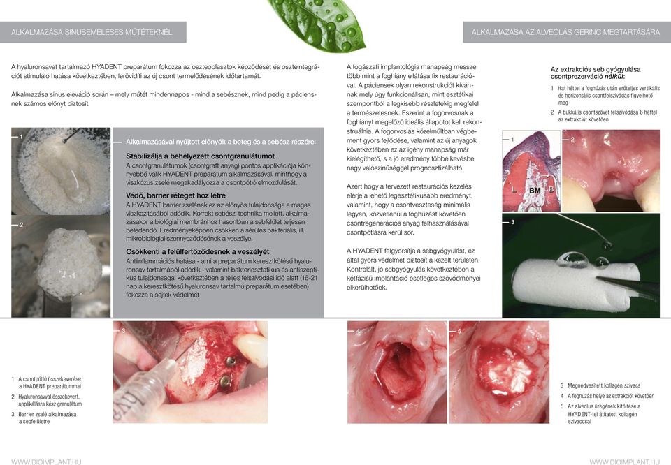 1 2 Alkalmazásával nyújtott előnyök a beteg és a sebész részére: Stabilizálja a behelyezett csontgranulátumot A csontgranulátumok (csontgraft anyag) pontos applikációja könnyebbé válik HYADENT