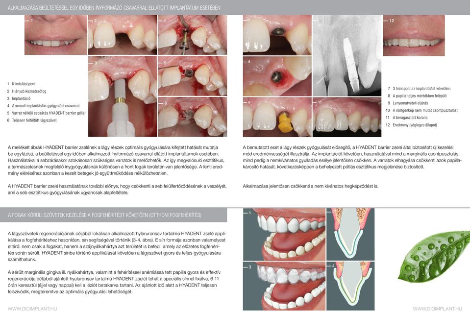 10 A röntgenkép nem mutat csontpusztulást 11 A beragasztott korona 12 Eredmény (végleges állapot) A mellékelt ábrák HYADENT barrier zselének a lágy részek optimális gyógyulására kifejtett hatását