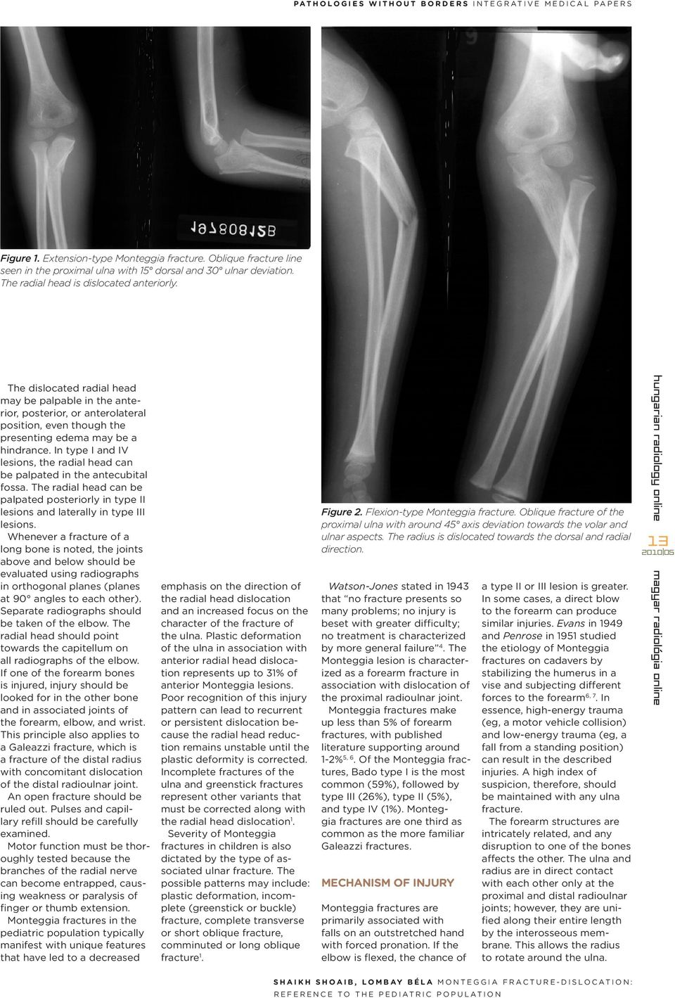 The dislocated radial head may be palpable in the anterior, posterior, or anterolateral position, even though the presenting edema may be a hindrance.