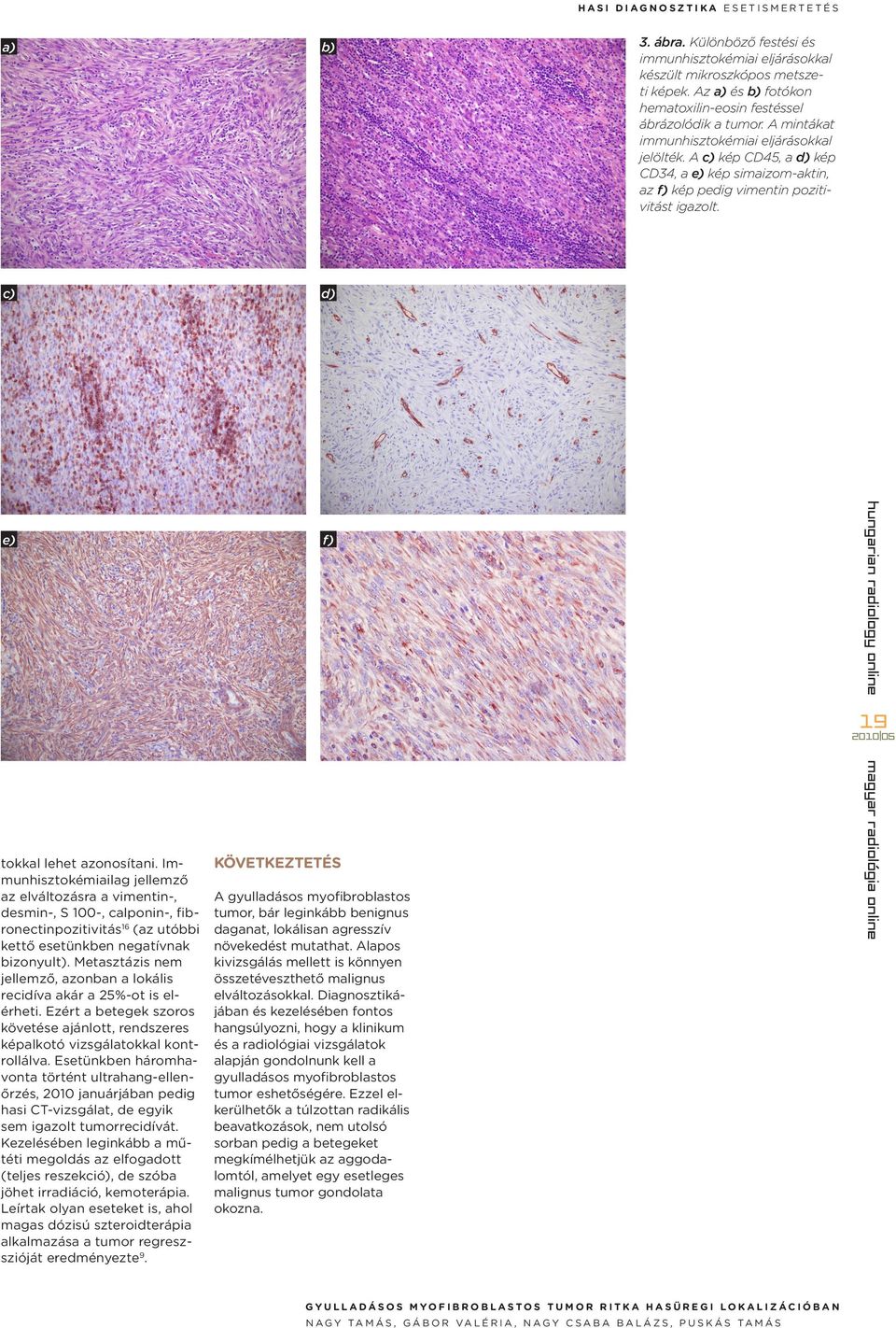 A c) kép CD45, a d) kép CD34, a e) kép simaizom-aktin, az f) kép pedig vimentin pozitivitást igazolt.