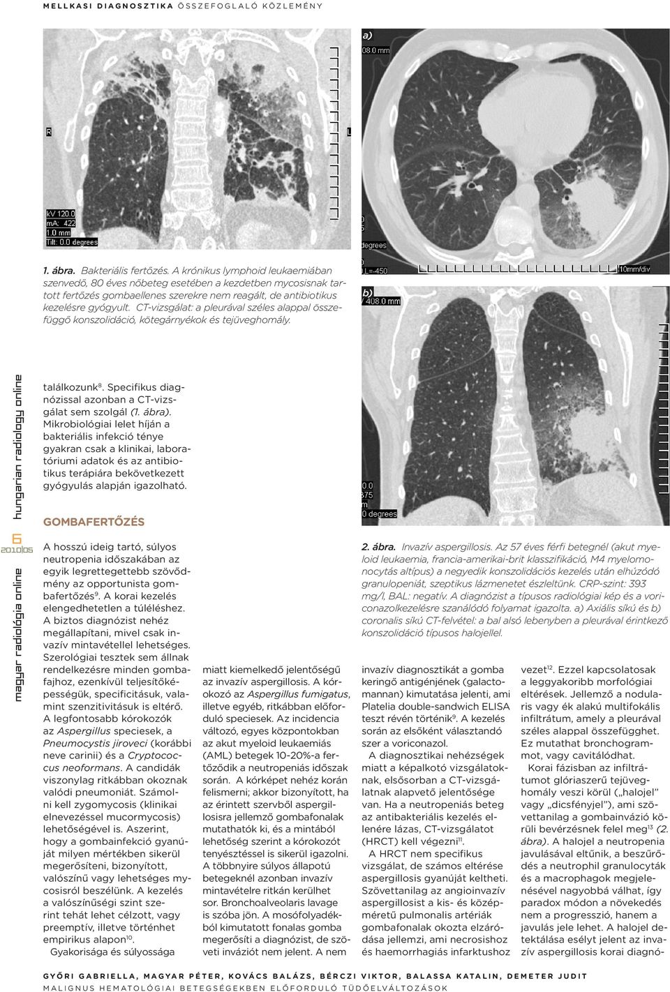 CT-vizsgálat: a pleurával széles alappal összefüggő konszolidáció, kötegárnyékok és tejüveghomály. b) 6 találkozunk 8. Specifikus diagnózissal azonban a CT-vizsgálat sem szolgál (1. ábra).