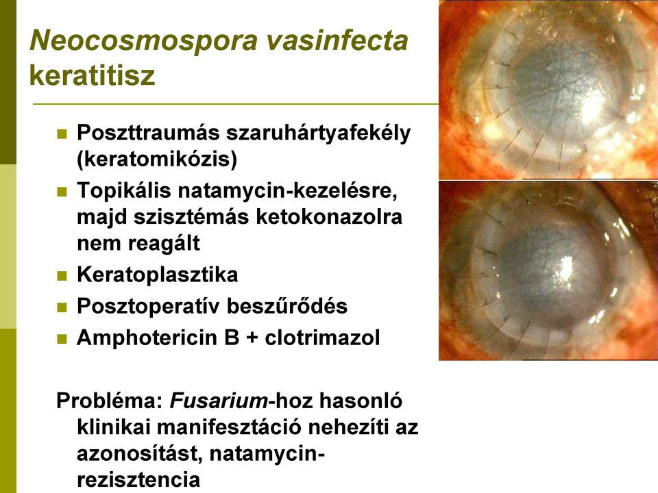 reagált Keratoplasztika Posztoperatív beszűrődés Amphotericin B + clotrimazol