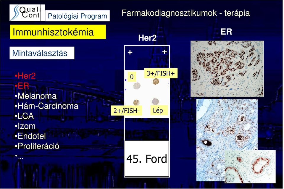 + ER Her2 ER Melanoma Hám-Carcinoma LCA Izom