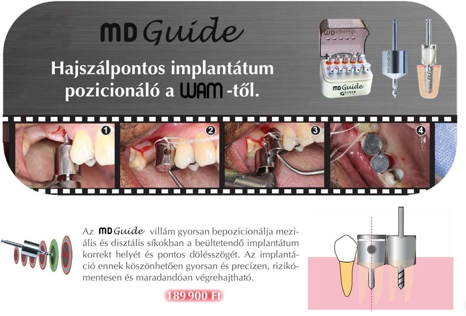 beültetendô implantátum korrekt helyét és pontos dölésszögét.