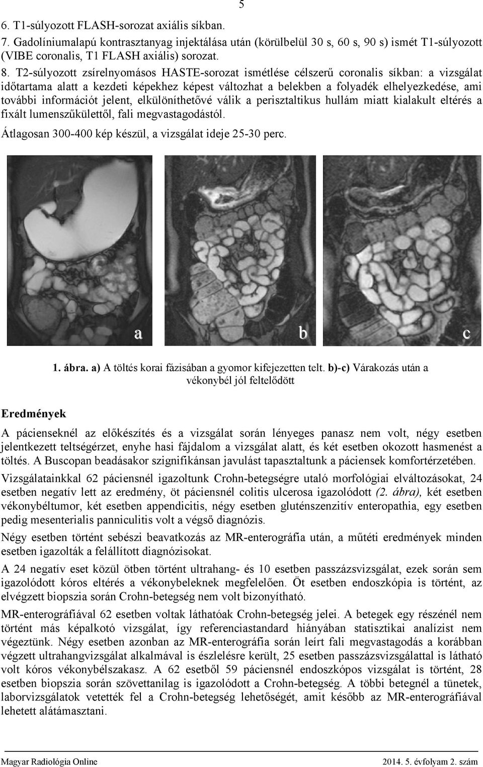 elkülöníthetővé válik perisztltikus hullám mitt kilkult eltérés fixált lumenszűkülettől, fli megvstgodástól. Átlgosn 300-400 kép készül, vizsgált ideje 25-30 perc. c 1. ár.