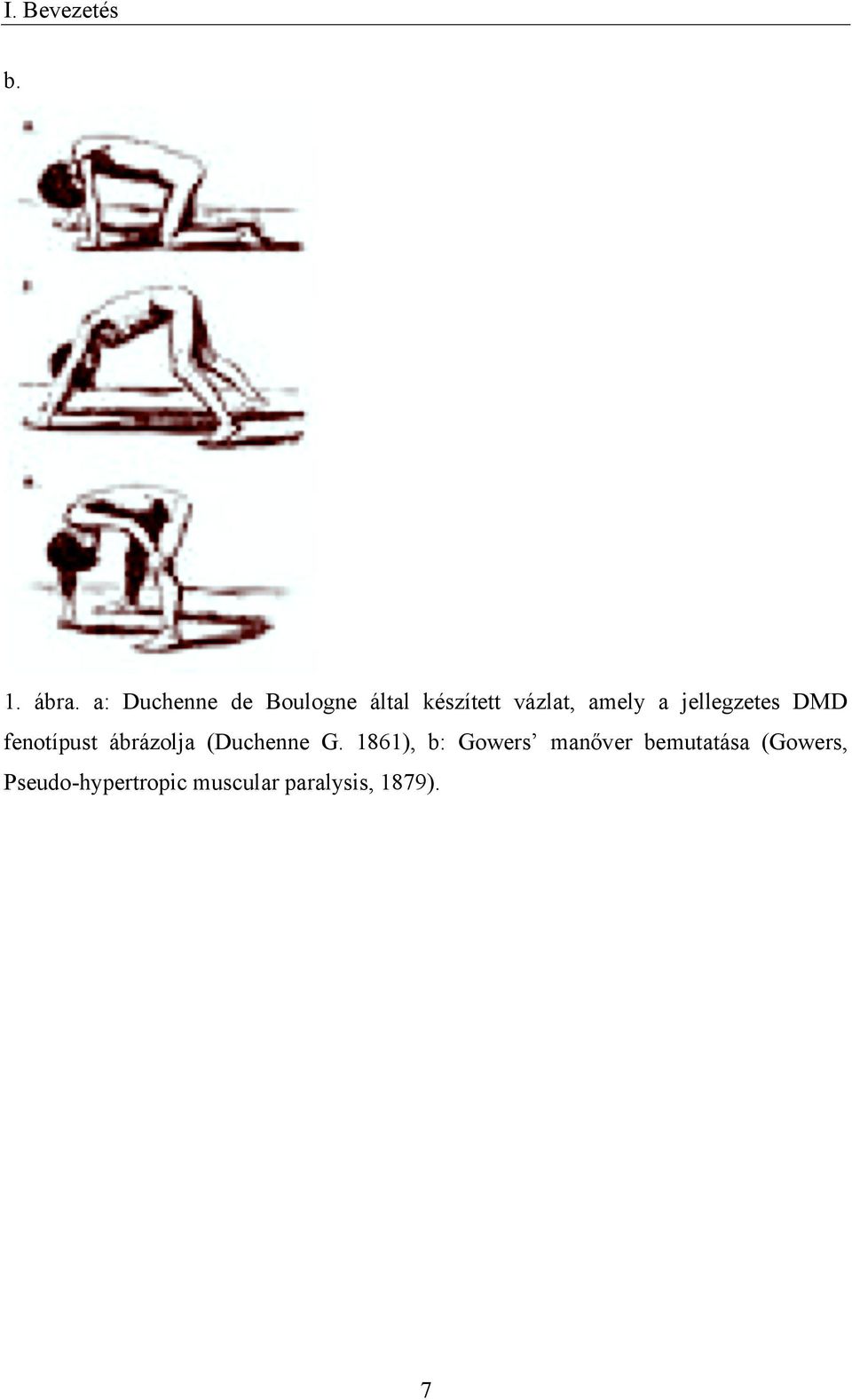 jellegzetes DMD fenotípust ábrázolja (Duchenne G.