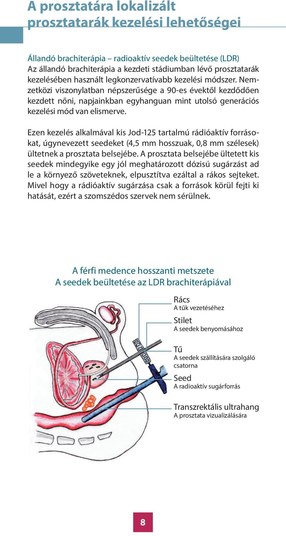 Ezen kezelés alkalmával kis Jod-125 tartalmú rádióaktív forrásokat, úgynevezett seedeket (4,5 mm hosszuak, 0,8 mm szélesek) ültetnek a prosztata belsejébe.