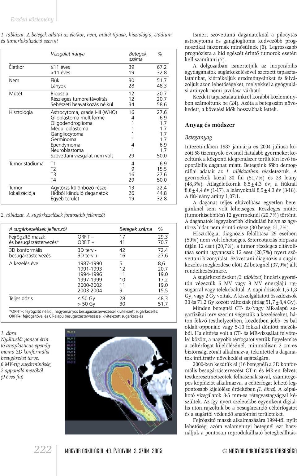 48,3 Mûtét Biopszia 12 20,7 Részleges tumoreltávolítás 12 20,7 Sebészeti beavatkozás nélkül 3458,6 Hisztológia Astrocytoma, grade I-III (WHO) 16 27,6 Glioblastoma multiforme 46,9 Oligodendroglioma 1