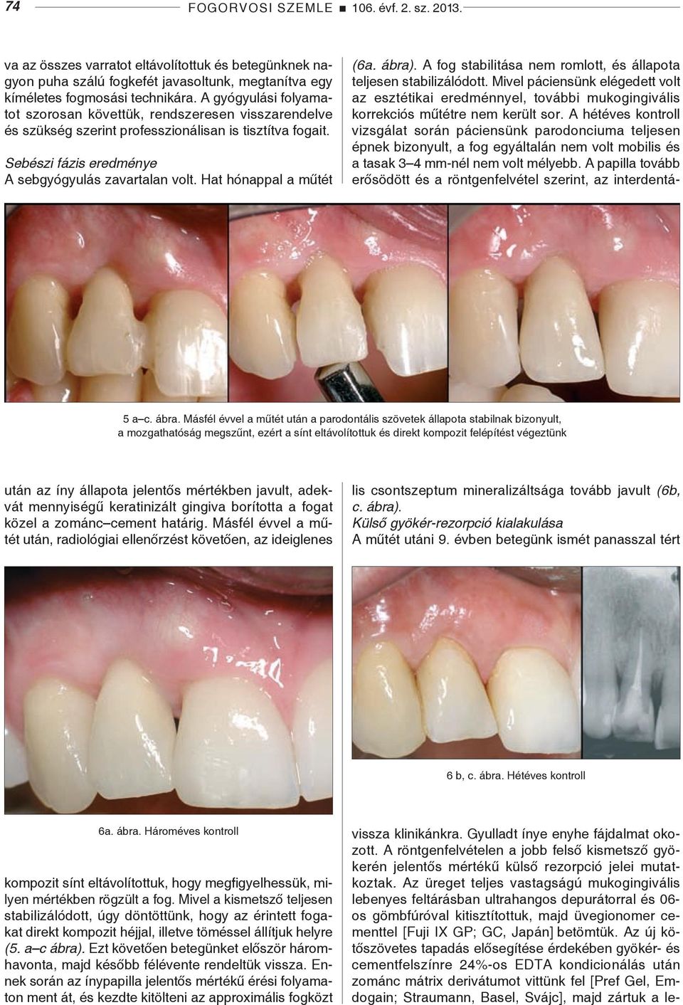 Hat hónappal a műtét (6a. ábra). A fog stabilitása nem romlott, és állapota teljesen stabilizálódott.