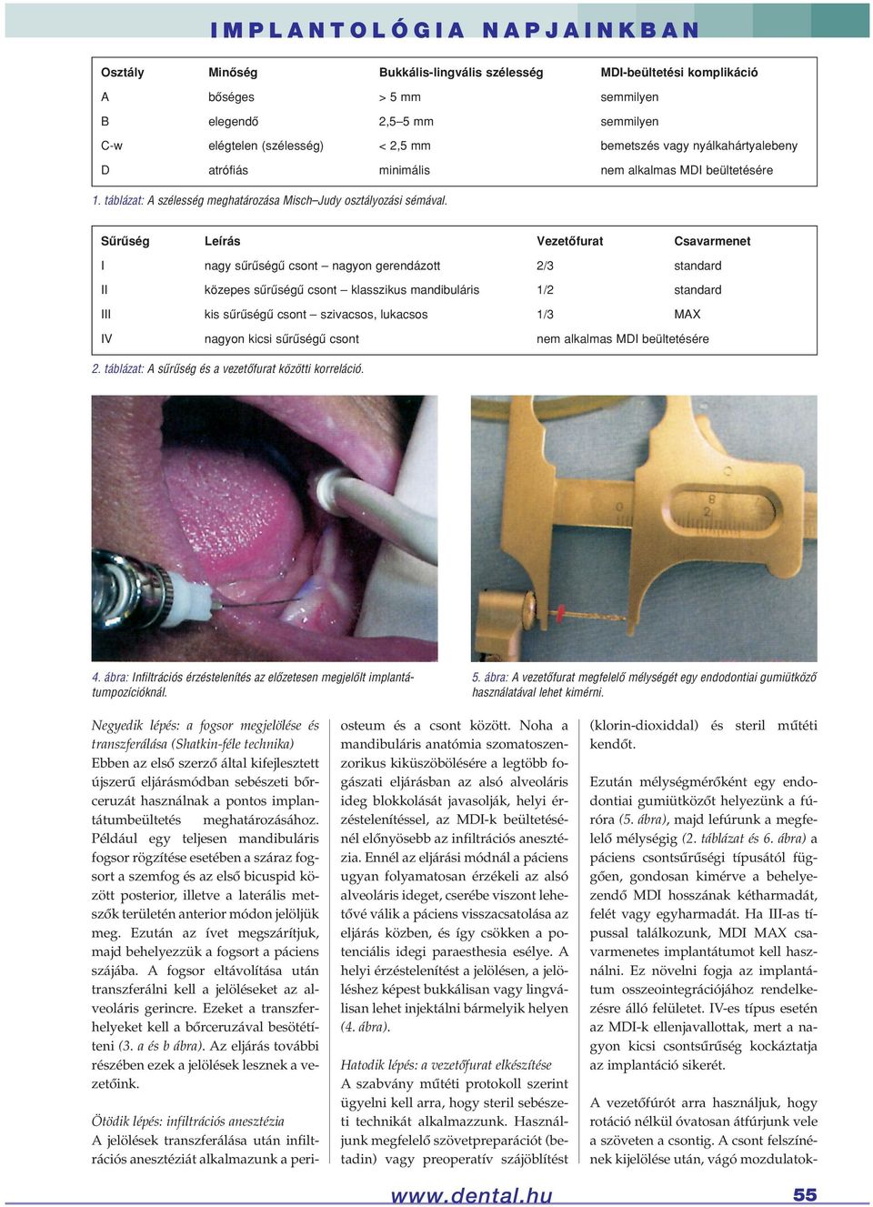 Sûrûség Leírás Vezetôfurat Csavarmenet I nagy sûrûségû csont nagyon gerendázott 2/3 standard II közepes sûrûségû csont klasszikus mandibuláris 1/2 standard III kis sûrûségû csont szivacsos, lukacsos