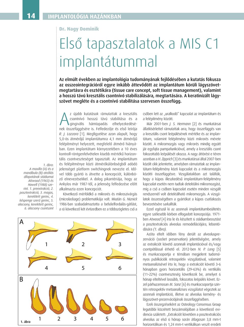 körüli lágyszövetmegtartásra és esztétikára (tissue care concept, soft tissue management), valamint a hosszú távú kresztális csontnívó stabilizálására, megtartására.