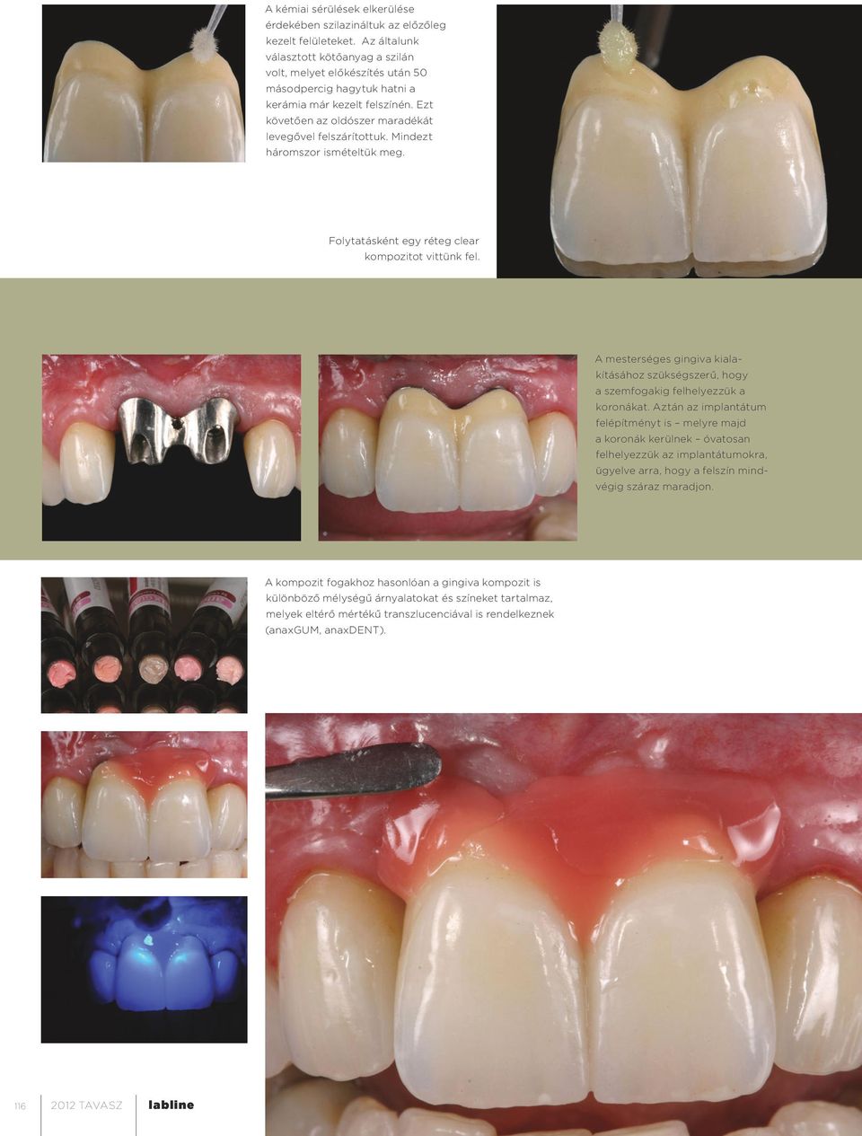 Mindezt háromszor ismételtük meg. Folytatásként egy réteg clear kompozitot vittünk fel. A mesterséges gingiva kialakításához szükségszerű, hogy a szemfogakig felhelyezzük a koronákat.