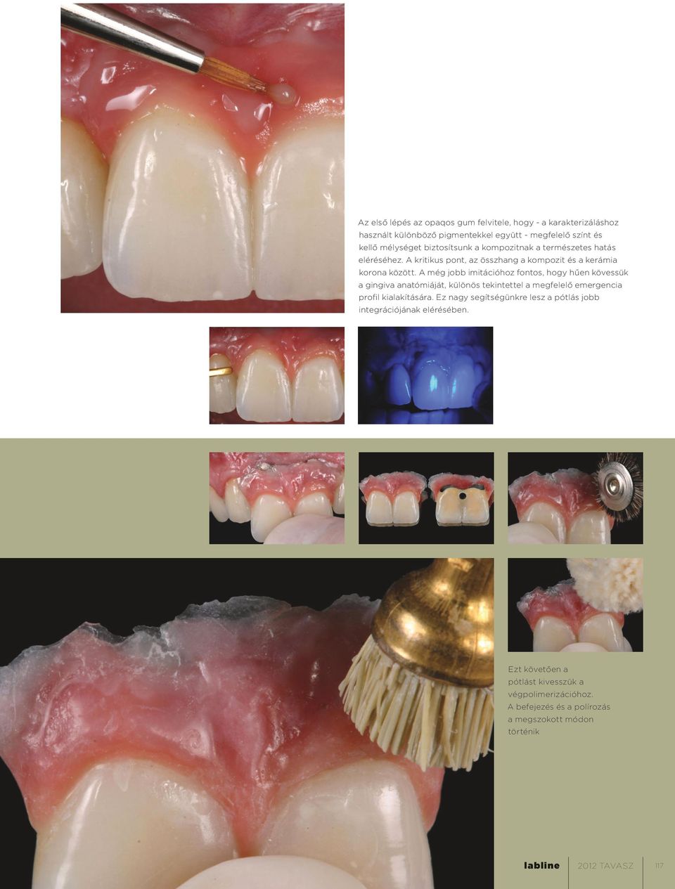 A még jobb imitációhoz fontos, hogy hűen kövessük a gingiva anatómiáját, különös tekintettel a megfelelő emergencia profil kialakítására.
