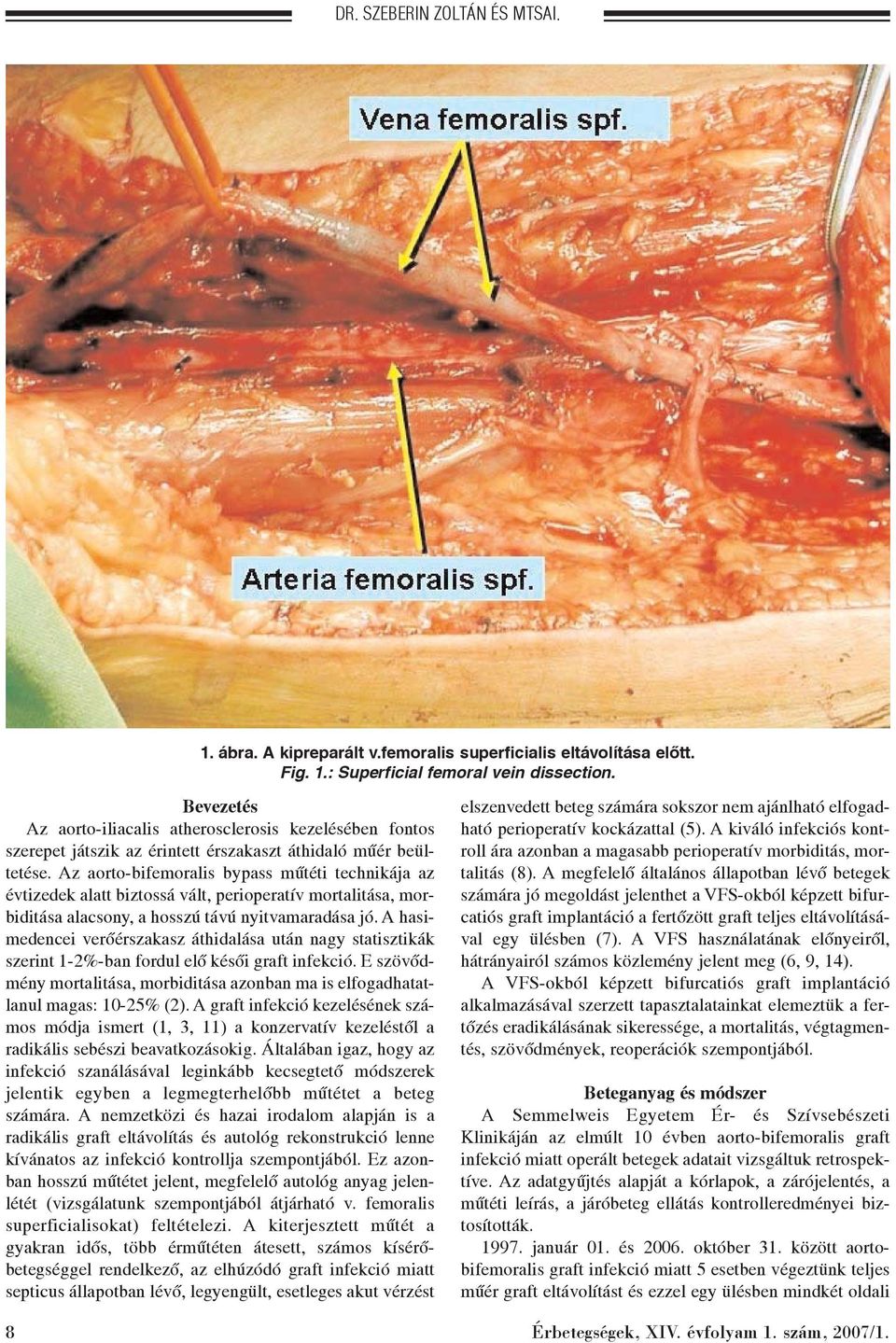 Az aorto-bifemoralis bypass mûtéti technikája az évtizedek alatt biztossá vált, perioperatív mortalitása, morbiditása alacsony, a hosszú távú nyitvamaradása jó.