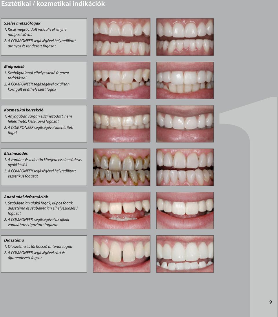 Anyagában sárgán elszíneződött, nem fehéríthető, kissé rövid fogazat 2. A Componeer segítségével kifehérített fogak Elszíneződés 1. A zománc és a dentin kiterjedt elszíneződése, nyaki léziók 2.