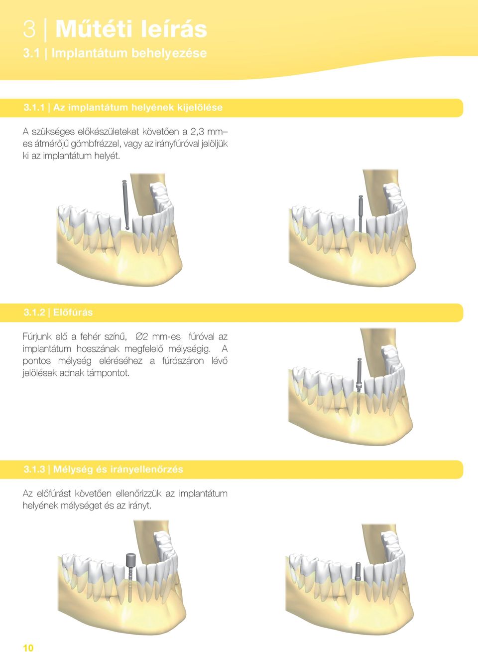 1 Az implantátum helyének kijelölése A szükséges előkészületeket követően a 2,3 mm es átmérőjű gömbfrézzel, vagy az
