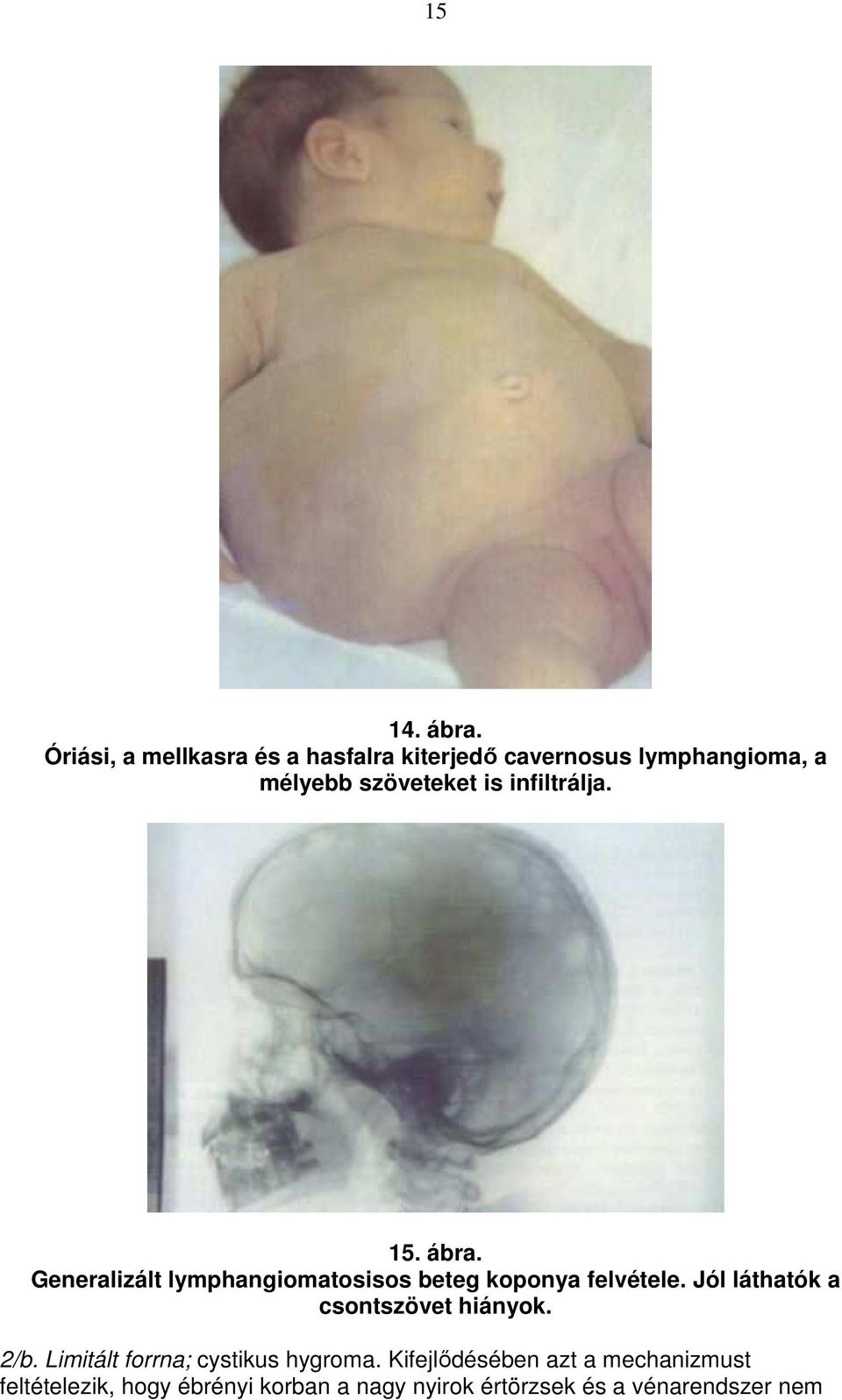 infiltrálja. 15. ábra. Generalizált lymphangiomatosisos beteg koponya felvétele.