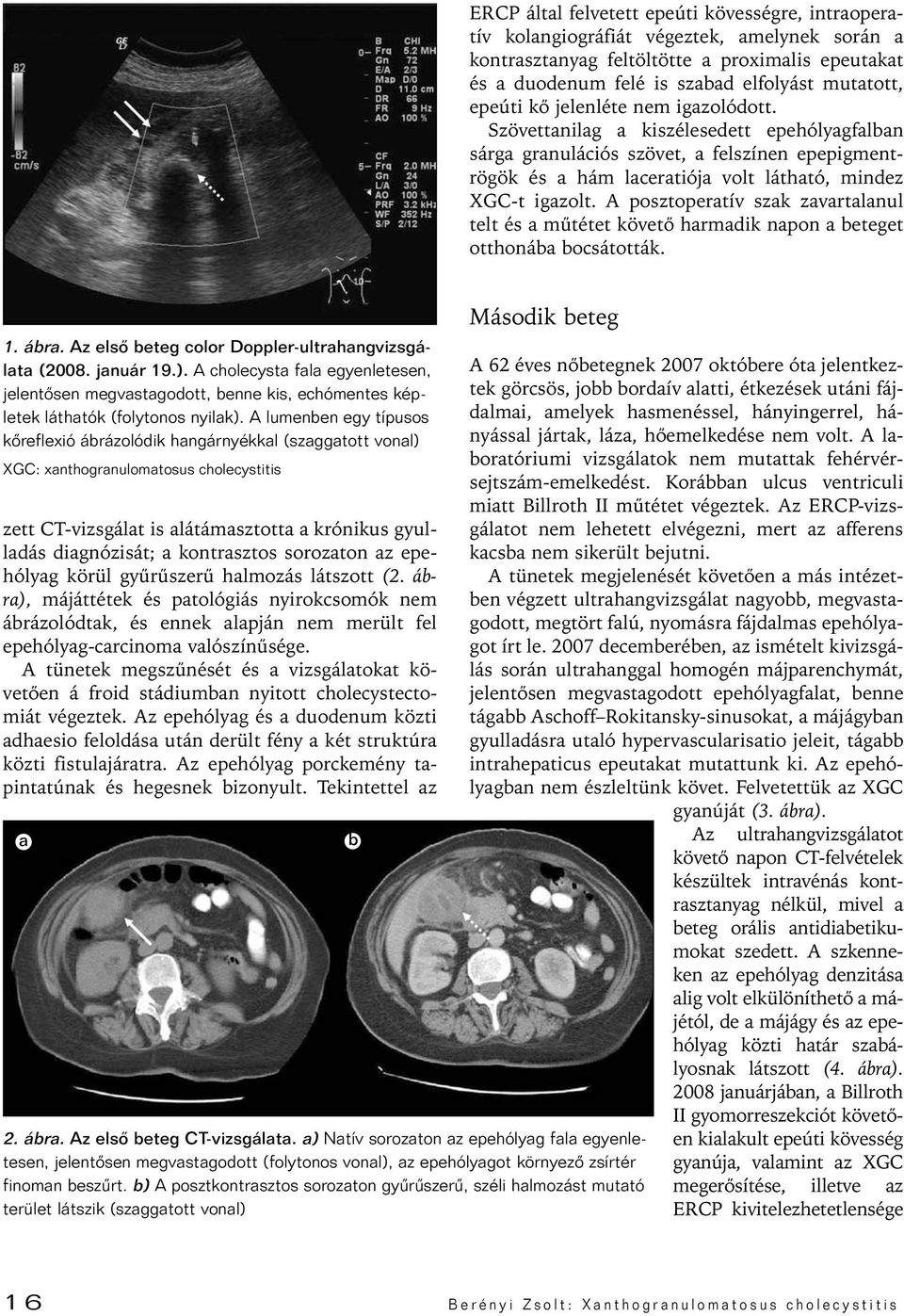 A posztoperatív szak zavartalanul telt és a mûtétet követô harmadik napon a beteget otthonába bocsátották. 1. ábra. Az elsô beteg color Doppler-ultrahangvizsgálata (2008. január 19.).