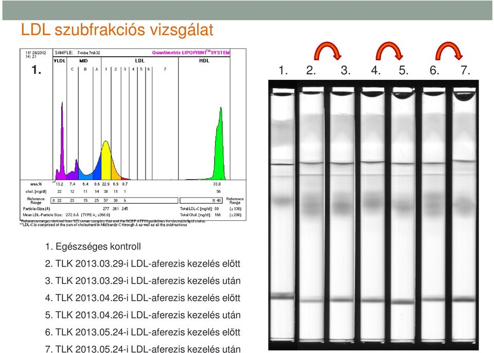 TLK 2013.04.26-i LDL-aferezis kezelés előtt 5. TLK 2013.04.26-i LDL-aferezis kezelés után 6.