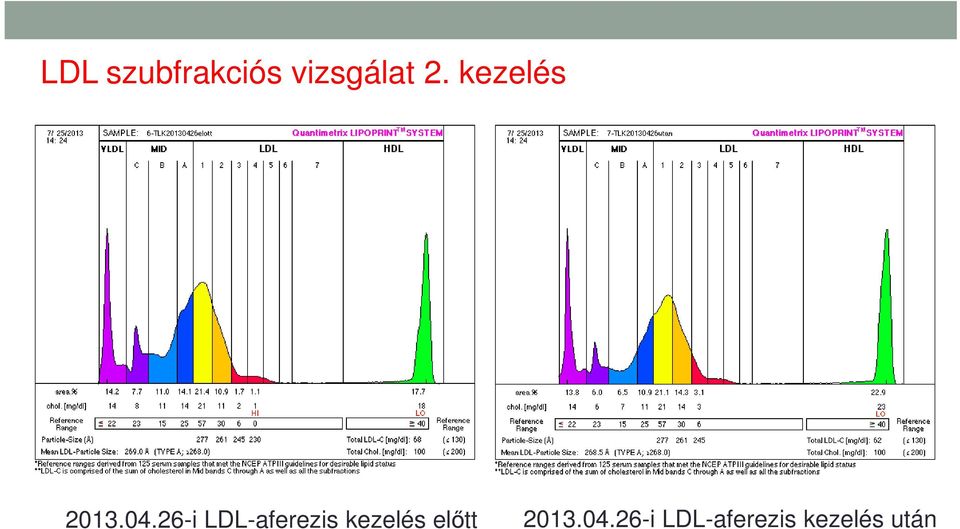 26-i LDL-aferezis kezelés