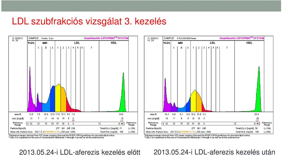 24-i LDL-aferezis kezelés