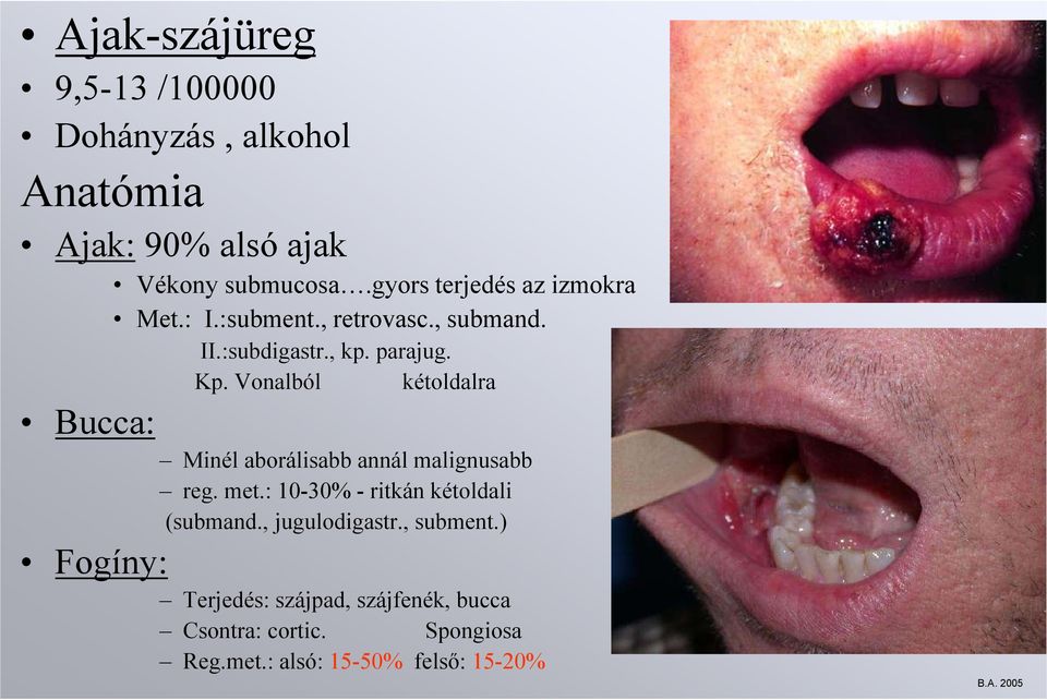 Vonalból kétoldalra Bucca: Minél aborálisabb annál malignusabb reg. met.: 10-30% - ritkán kétoldali (submand.