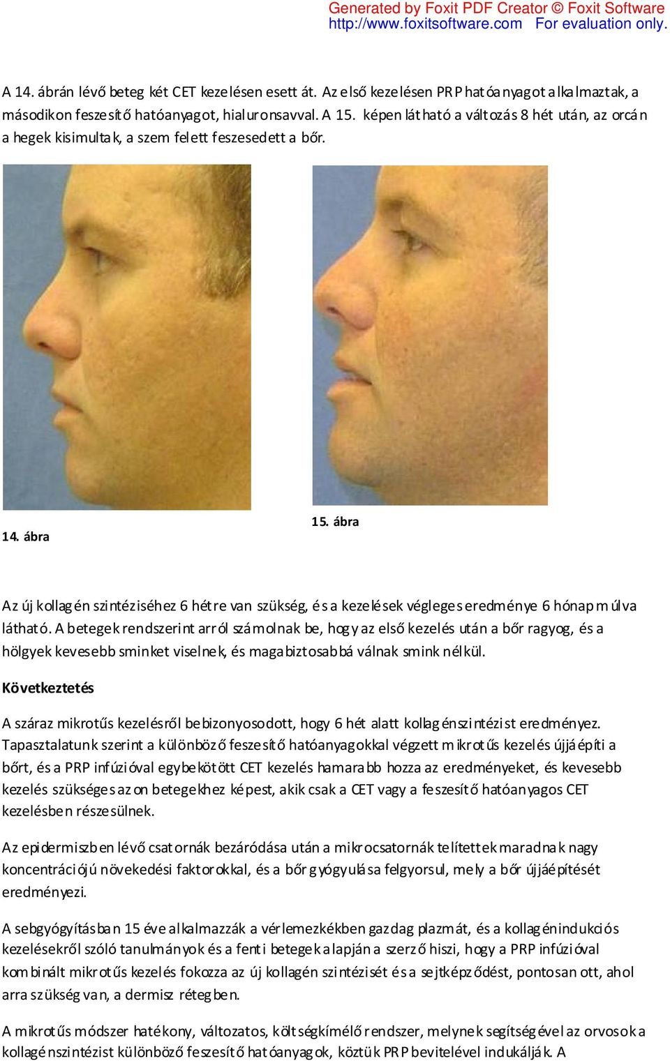 ábra Az új kollagén szintéziséhez 6 hétre van szükség, és a kezelések végleges eredménye 6 hónap m úlva látható.