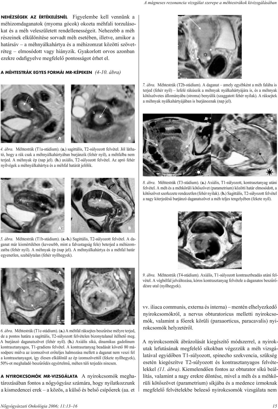 Gyakorlott orvos azonban ezekre odafigyelve megfelelô pontosságot érhet el. A MÉHTESTRÁK EGYES FORMÁI MR-KÉPEKEN (4-10. ábra) 7. ábra. Méhtestrák (T2b-stádium).