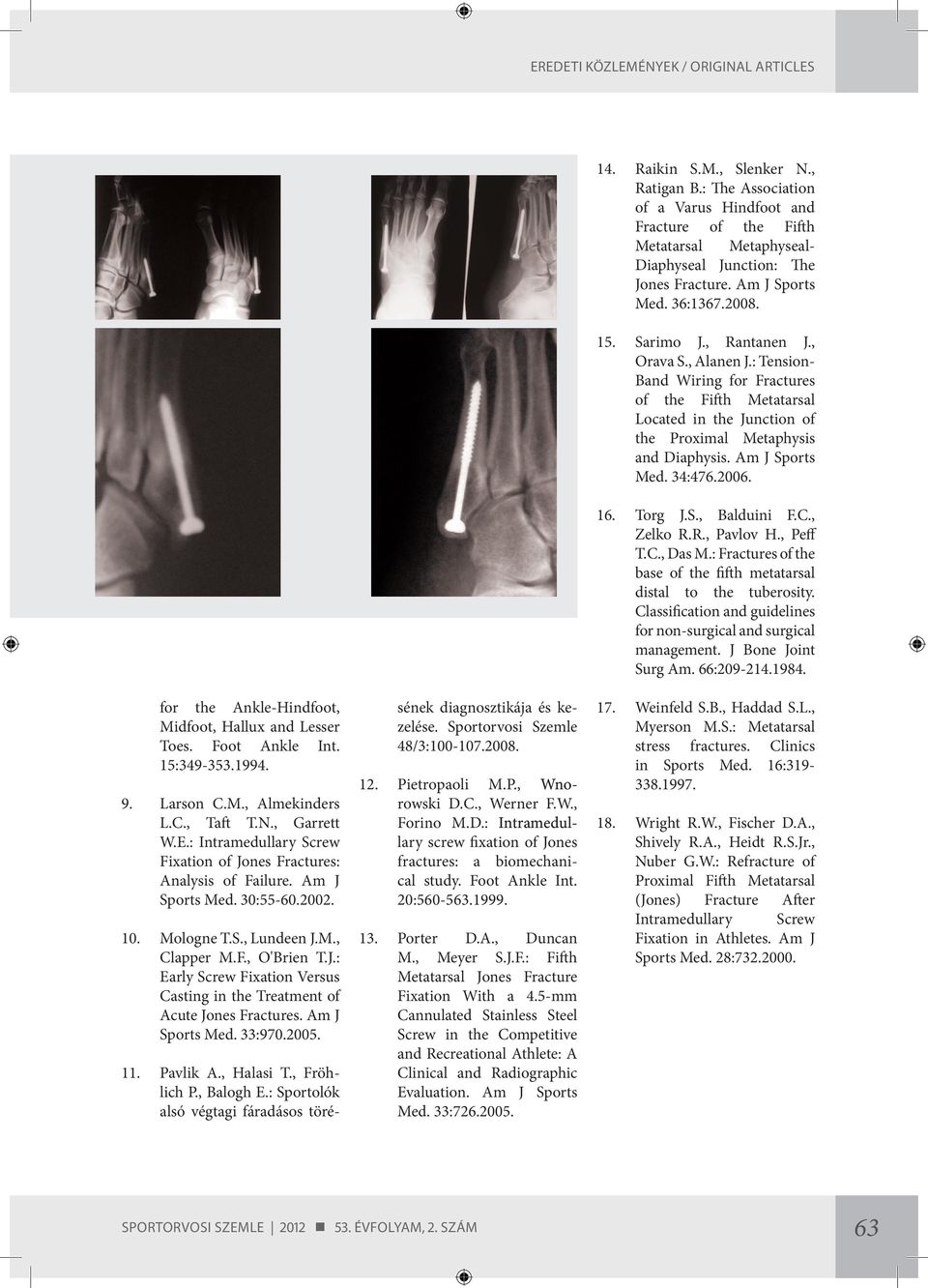 2006. 16. Torg J.S., Balduini F.C., Zelko R.R., Pavlov H., Peff T.C., Das M.: Fractures of the base of the fifth metatarsal distal to the tuberosity.