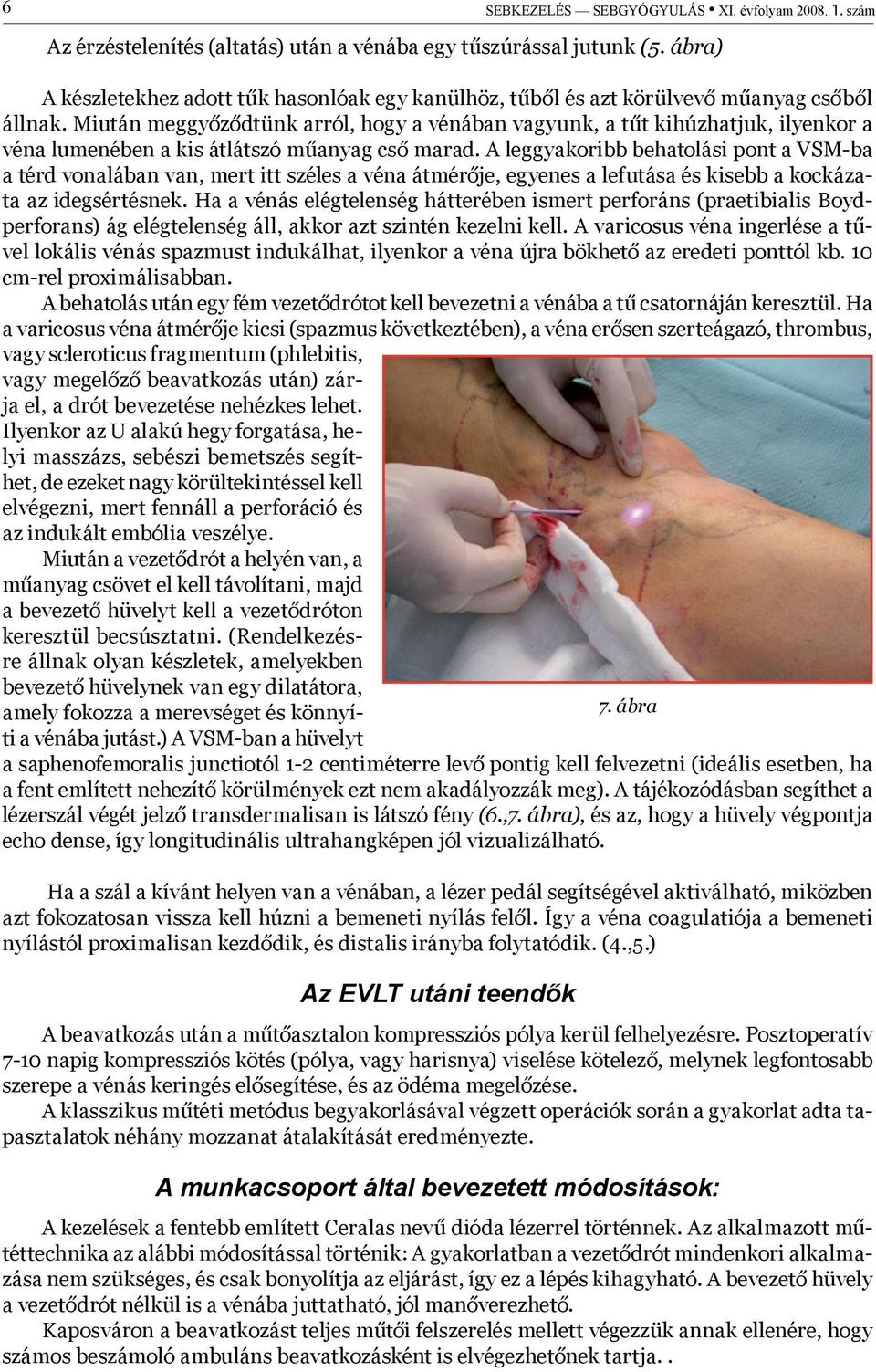 Miután meggyőződtünk arról, hogy a vénában vagyunk, a tűt kihúzhatjuk, ilyenkor a véna lumenében a kis átlátszó műanyag cső marad.