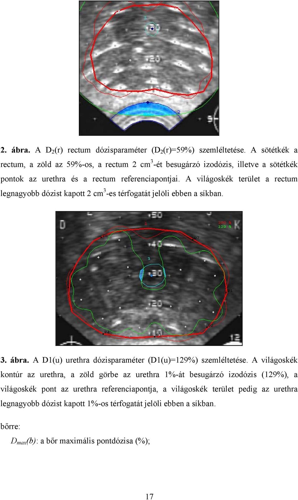 A világoskék terület a rectum legnagyobb dózist kapott 2 cm 3 -es térfogatát jelöli ebben a síkban. 3. ábra. A D1(u) urethra dózisparaméter (D1(u)=129%) szemléltetése.