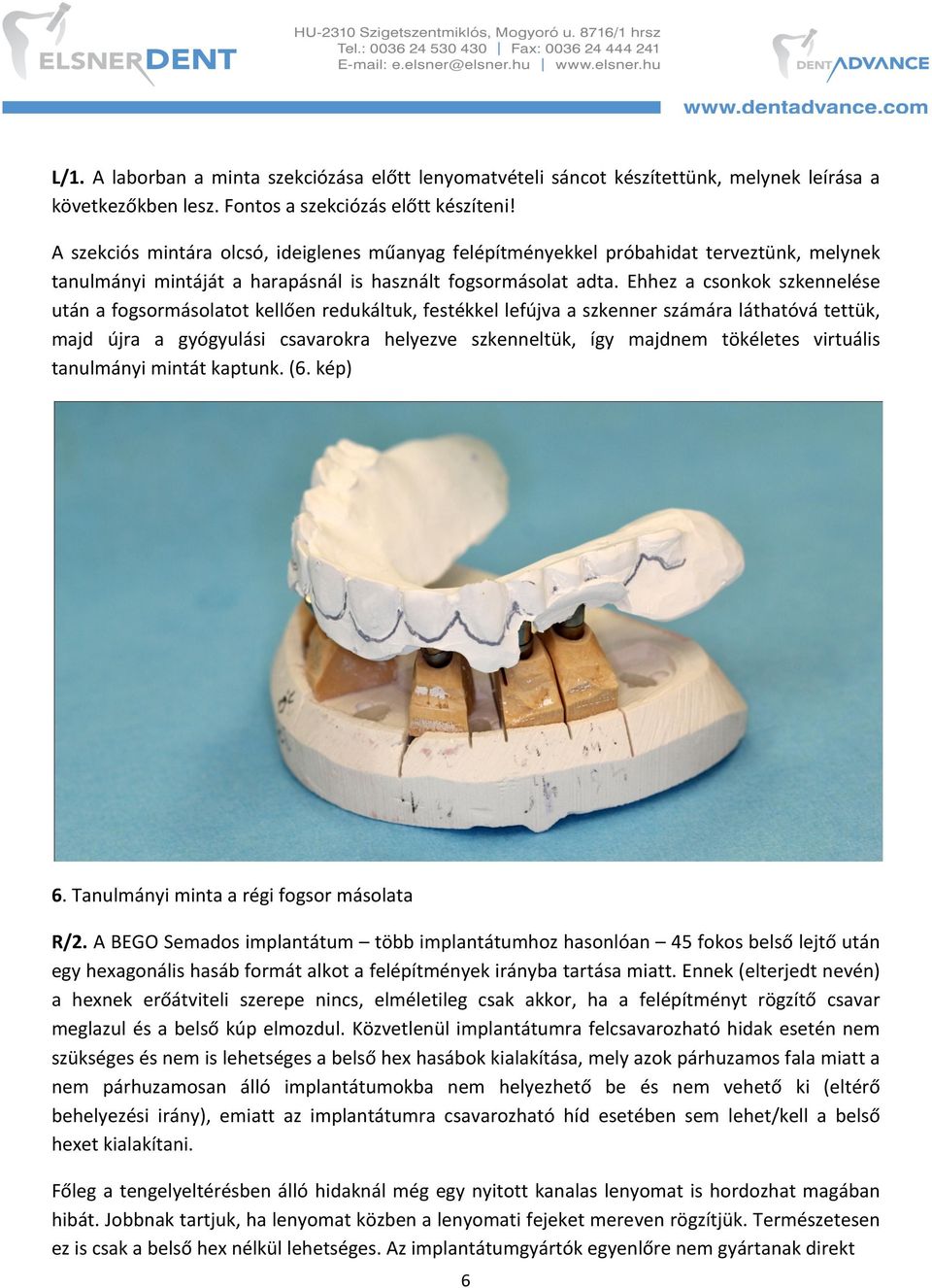 Ehhez a csonkok szkennelése után a fogsormásolatot kellően redukáltuk, festékkel lefújva a szkenner számára láthatóvá tettük, majd újra a gyógyulási csavarokra helyezve szkenneltük, így majdnem