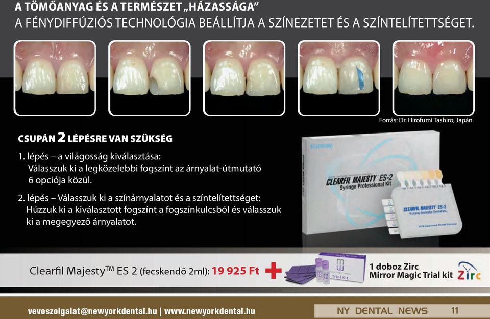 lépés Válasszuk ki a színárnyalatot és a színtelítettséget: Húzzuk ki a kiválasztott fogszínt a fogszínkulcsból és válasszuk ki a megegyező árnyalatot.