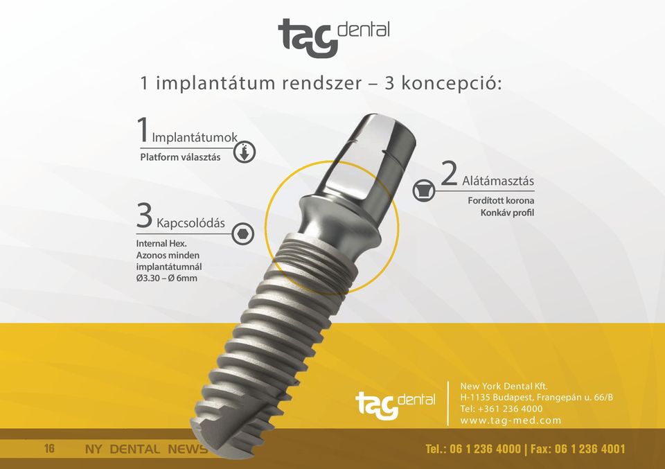30 Ø 6mm 2 Alátámasztás Fordított korona New York Dental Kft.
