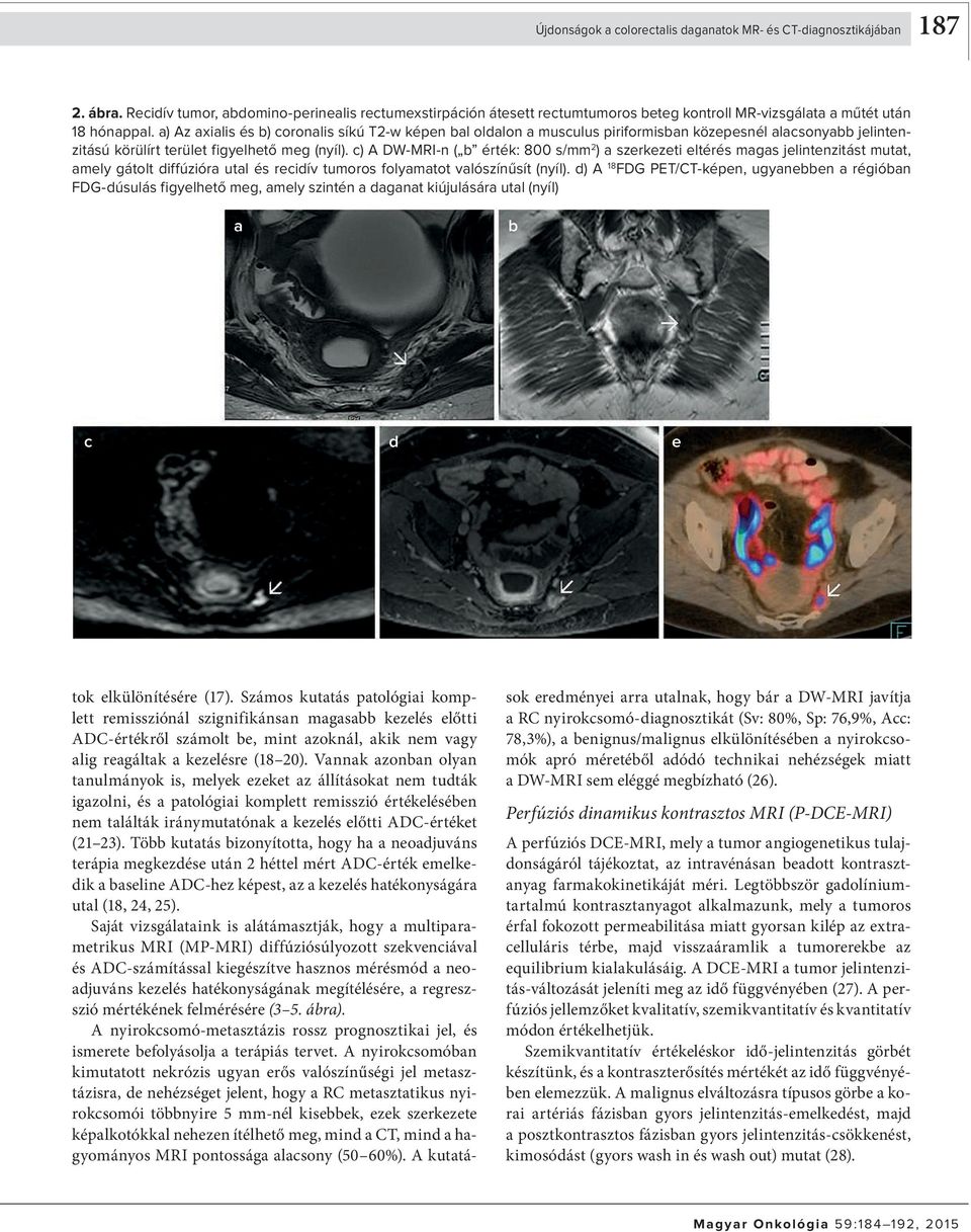 c) A DW-MRI-n ( érték: 800 s/mm 2 ) szerkezeti eltérés mgs jelintenzitást mutt, mely gátolt diffúziór utl és recidív tumoros folymtot vlószínűsít (nyíl).