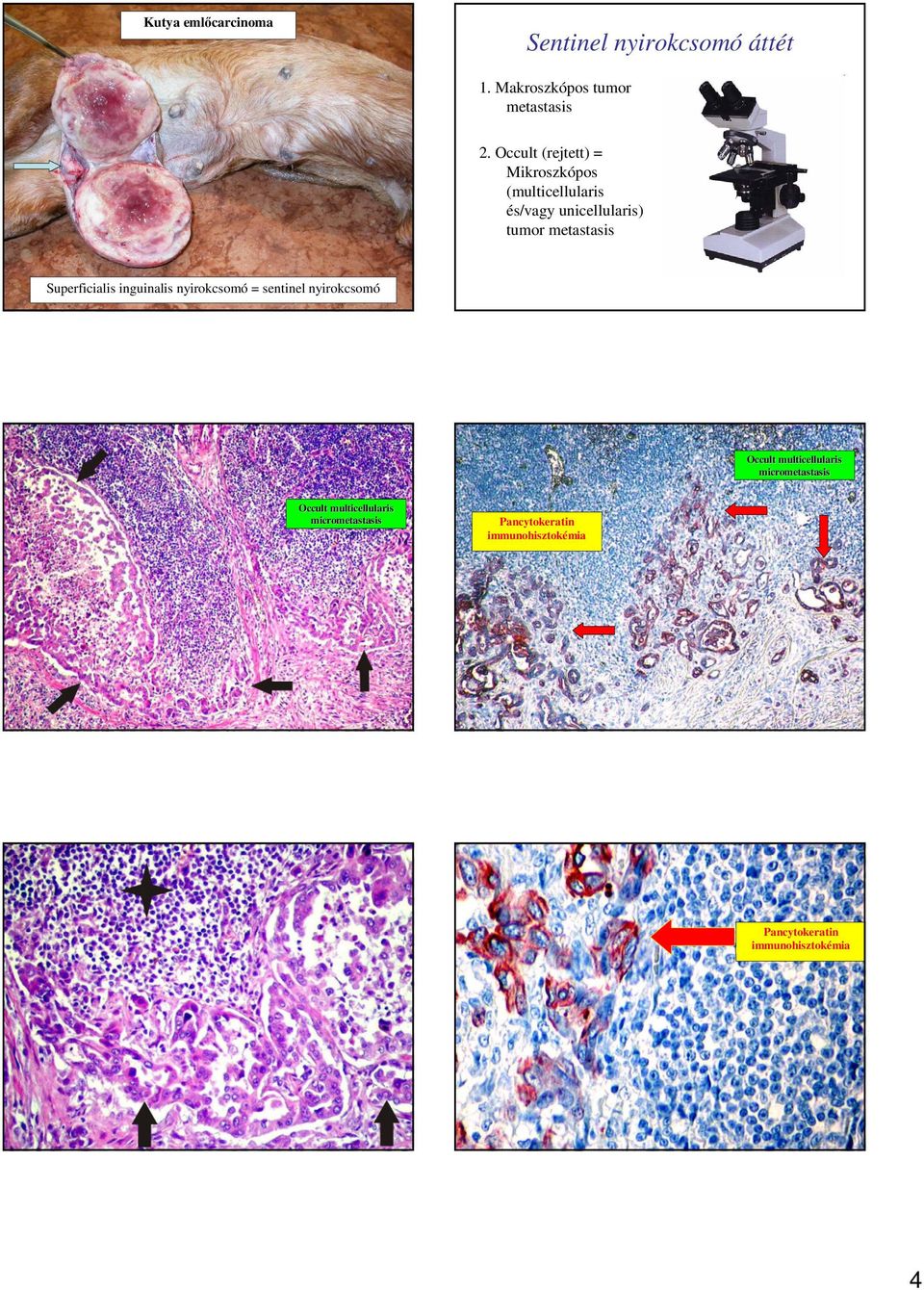 Superficialis inguinalis nyirokcsomó = sentinel nyirokcsomó Occult multicellularis