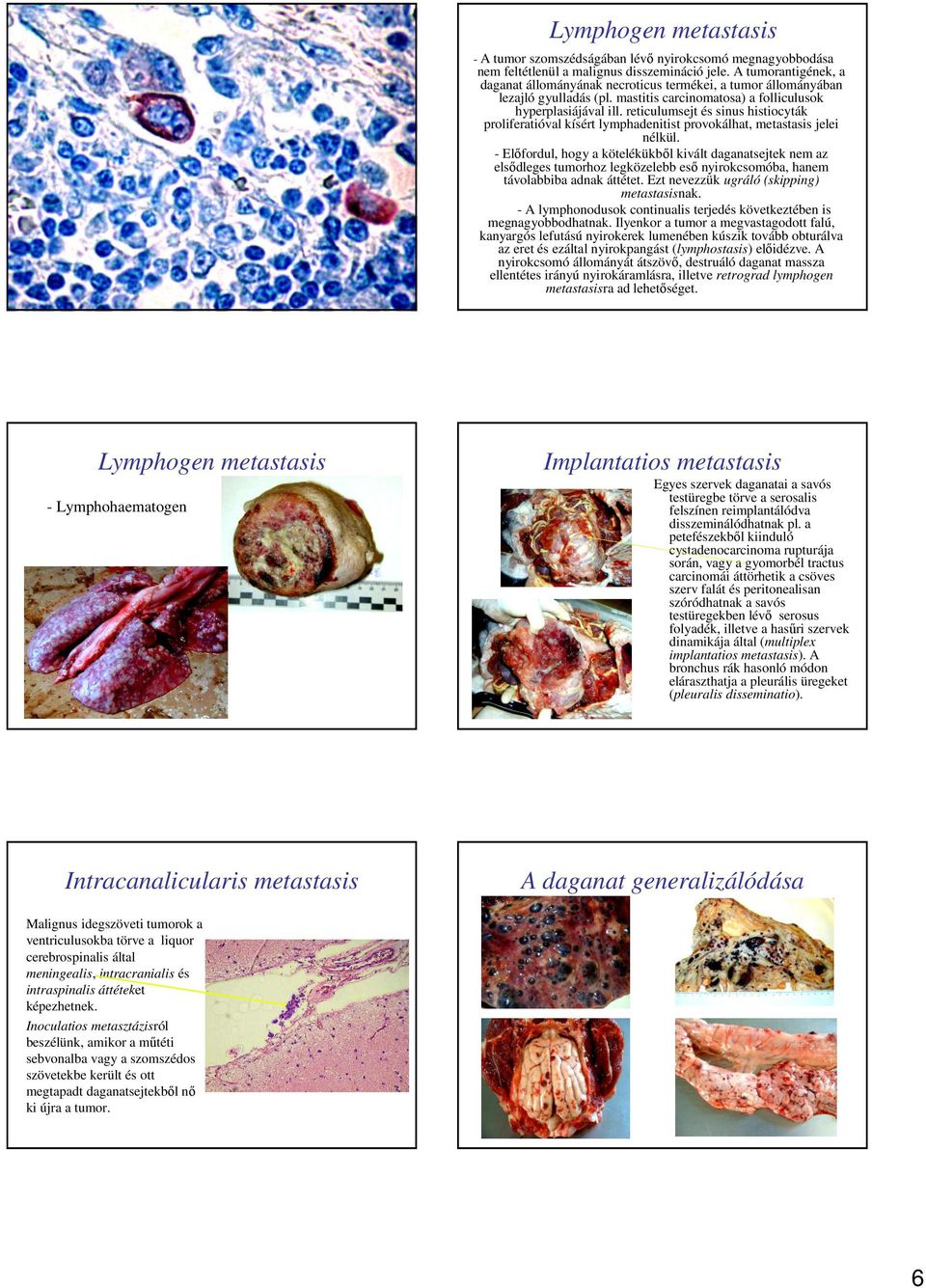 reticulumsejt és sinus histiocyták proliferatióval kísért lymphadenitist provokálhat, metastasis jelei nélkül.