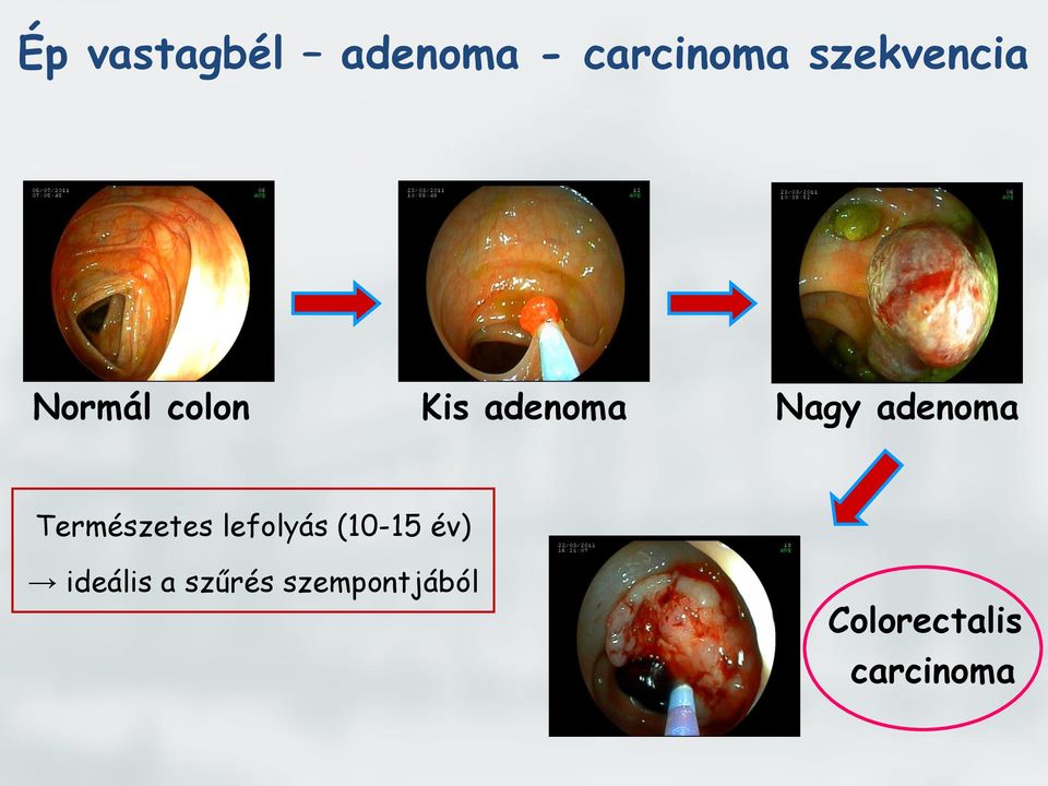 adenoma Természetes lefolyás (10-15 év)