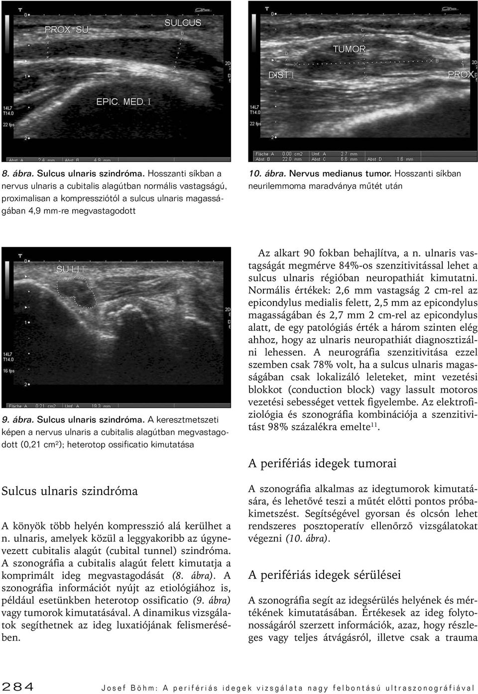 A keresztmetszeti képen a nervus ulnaris a cubitalis alagútban megvastagodott (0,21 cm²); heterotop ossificatio kimutatása Sulcus ulnaris szindróma A könyök több helyén kompresszió alá kerülhet a n.