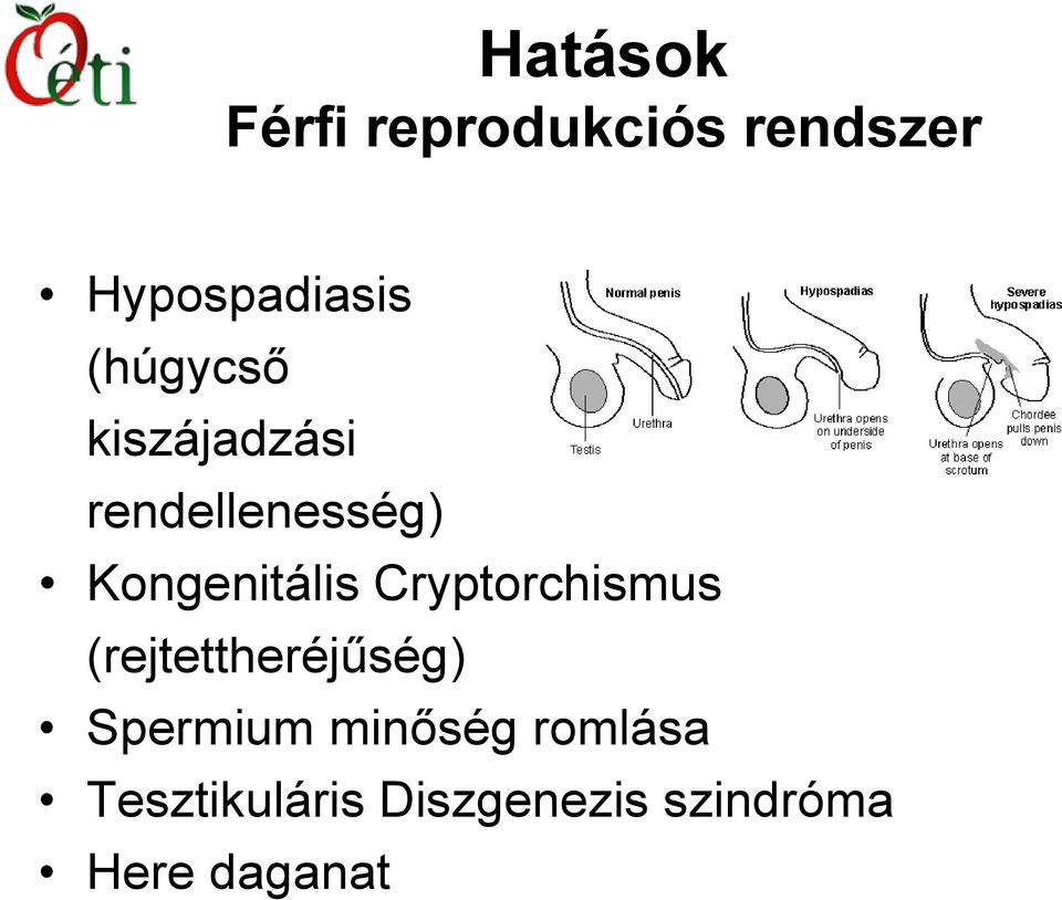 Cryptorchismus (rejtettheréjűség) Spermium minőség