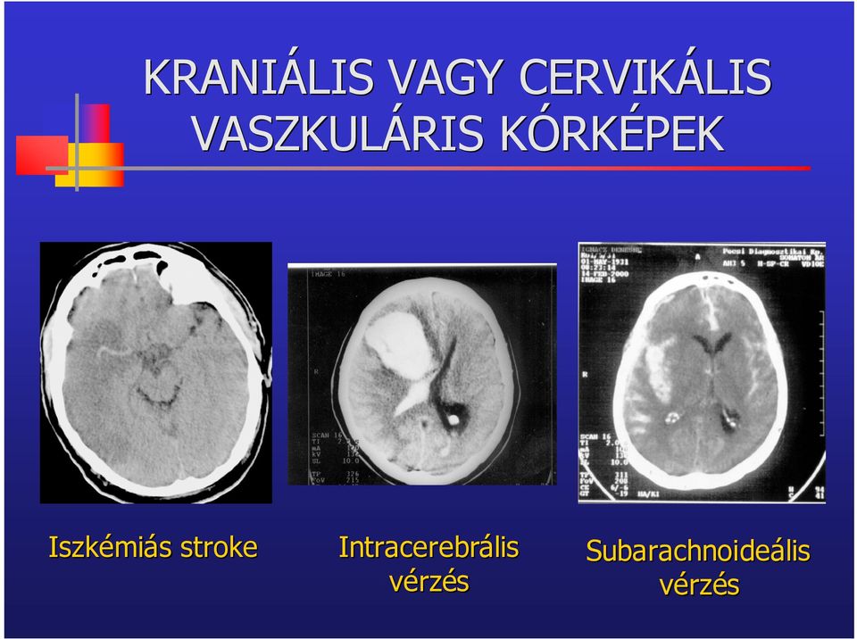 zkémiás stroke