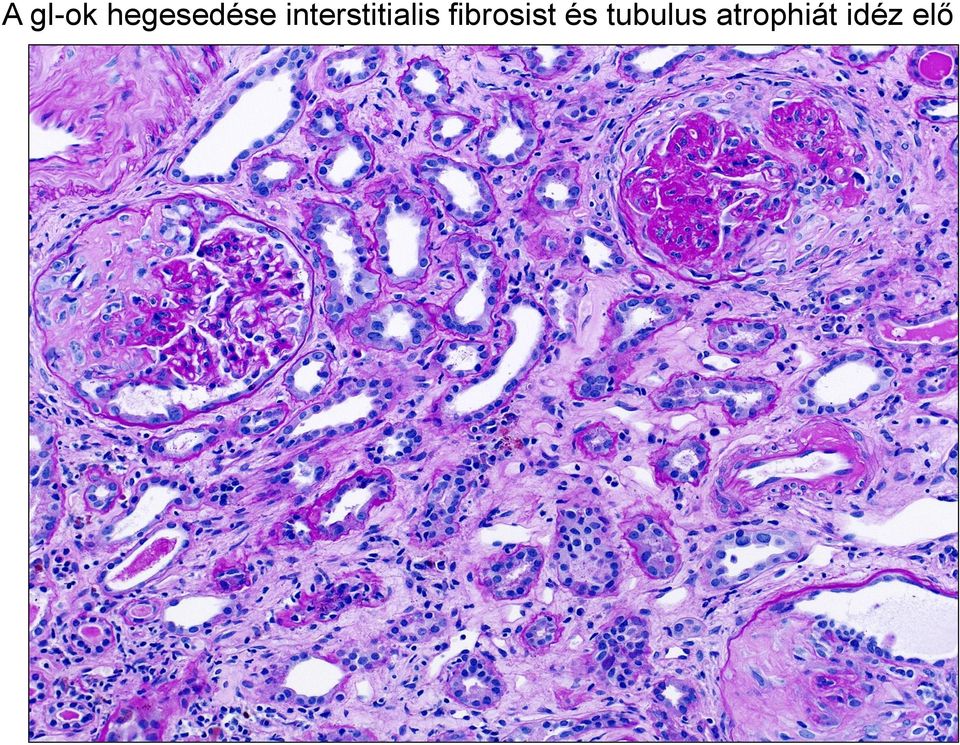 fibrosist és