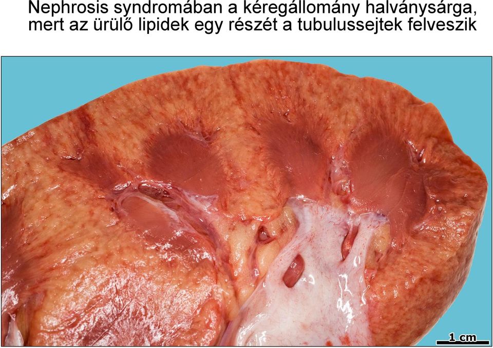 mert az ürülő lipidek egy