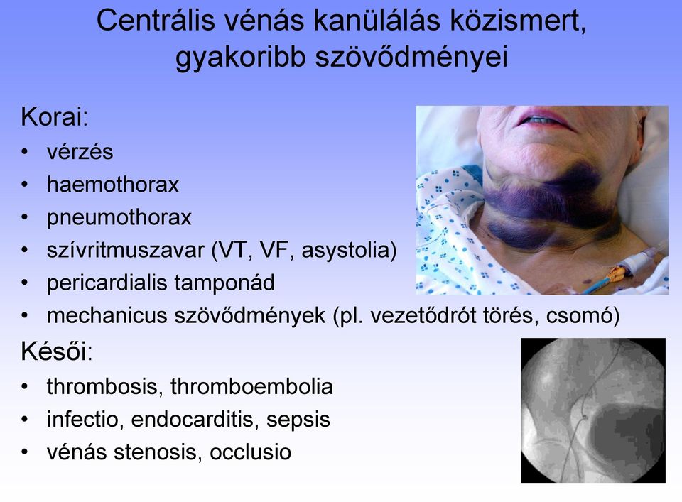 tamponád mechanicus szövődmények (pl.