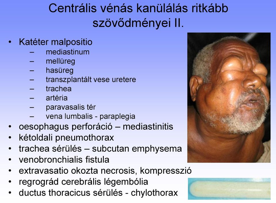 tér vena lumbalis - paraplegia oesophagus perforáció mediastinitis kétoldali pneumothorax trachea